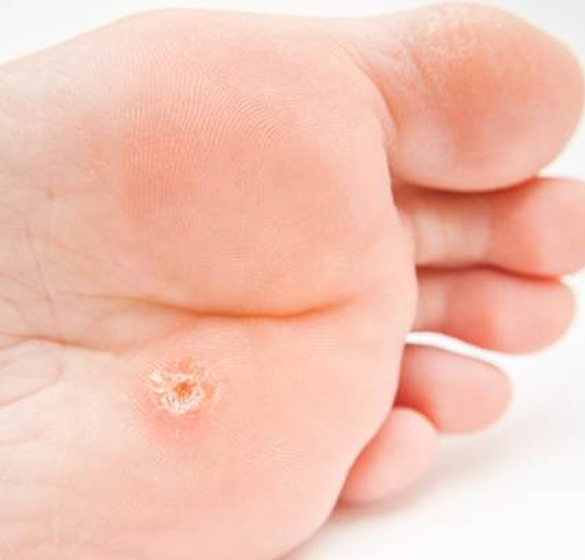 Como tratar e prevenir verrugas?